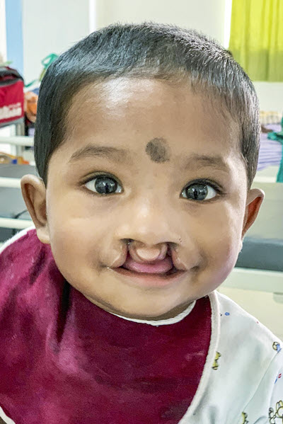 Image of a child smiling with a cleft palate